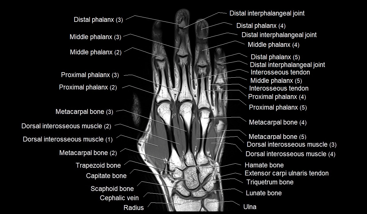 MRI 3T coronal hand cross sectional anatomy image 12.webp